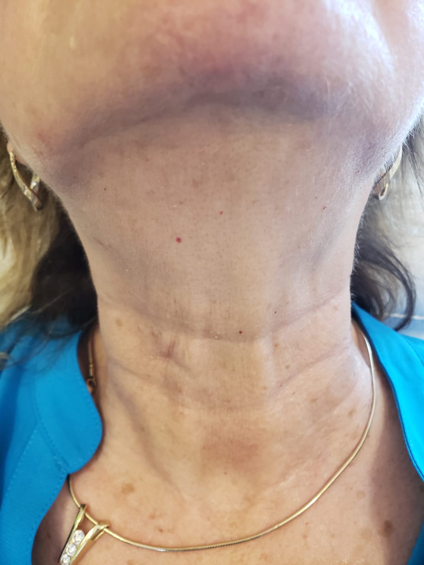 Neck lifting result — after