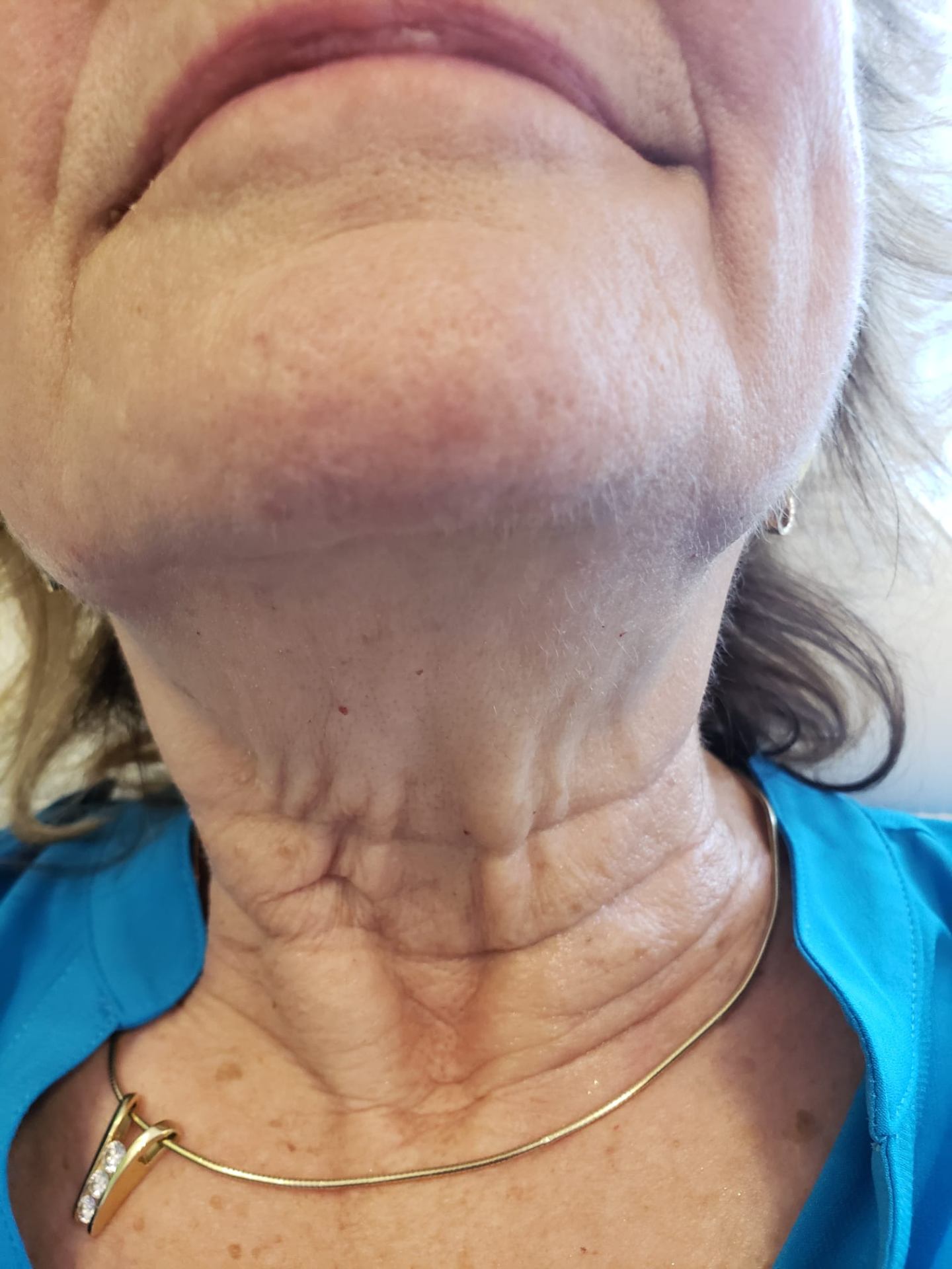 Neck lifting result — before